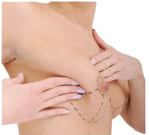 trulife-breastform